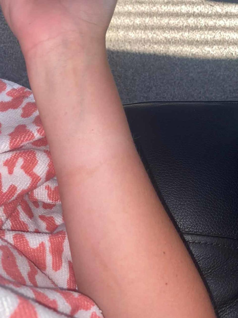 Paige’s arm while it was healing. PA REAL LIFE COLLECT