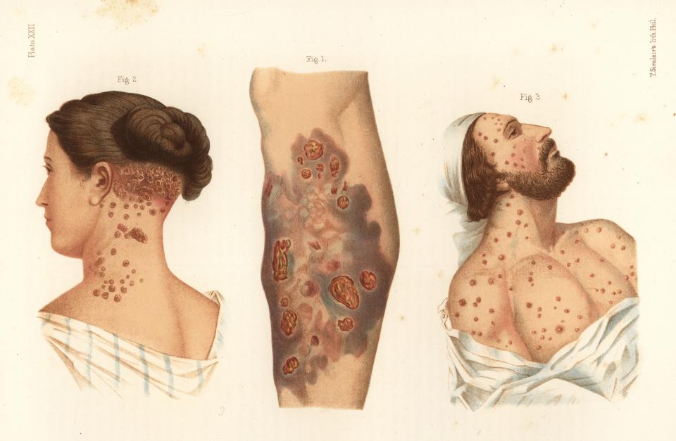 Illustration shows a boil and necrosis associated with untreated syphilis.