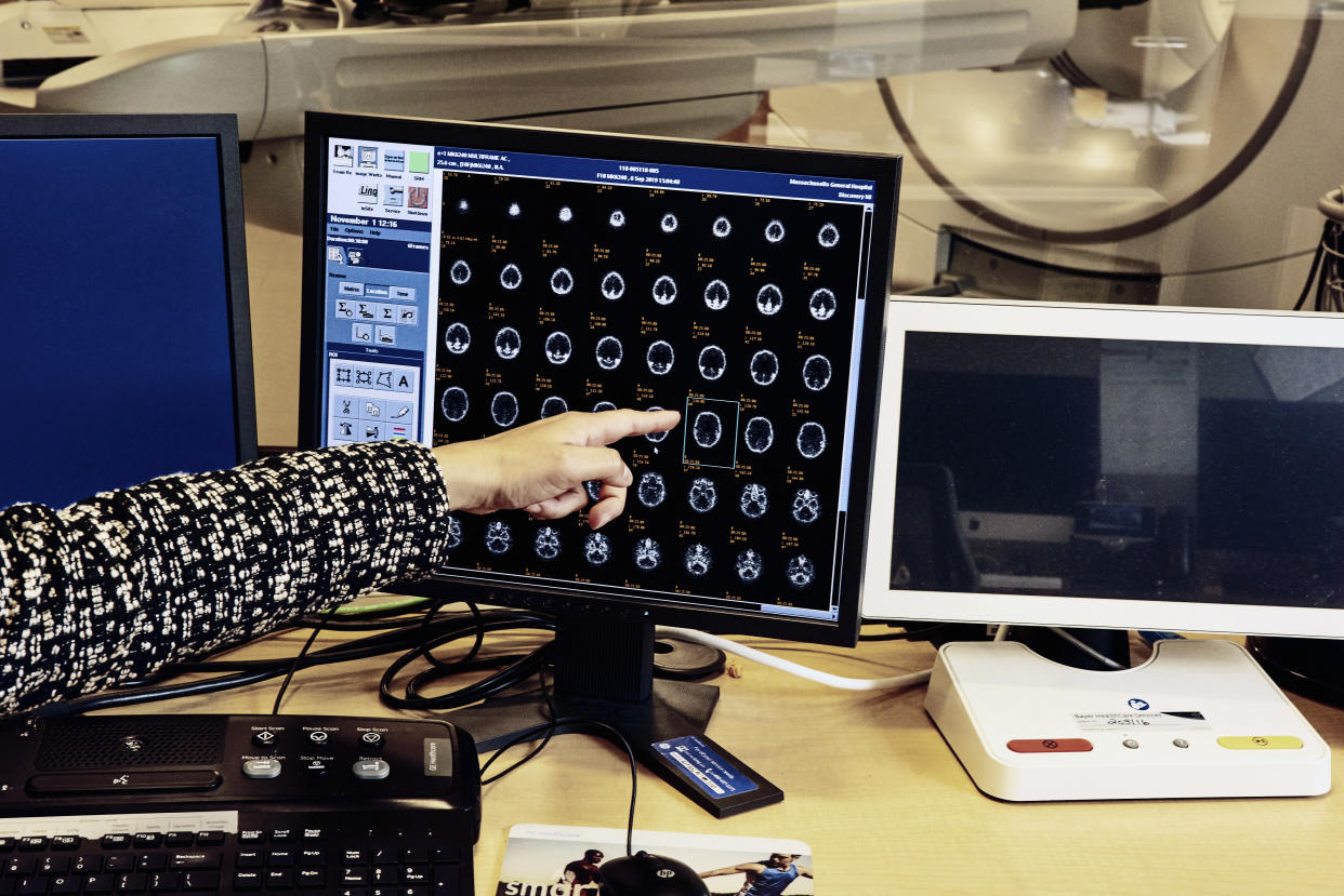 Imágenes del cerebro de un paciente con alzhéimer en una tomografía por emisión de positrones, en el Hospital General de Massachusetts de Boston. (Tony Luong/The New York Times)