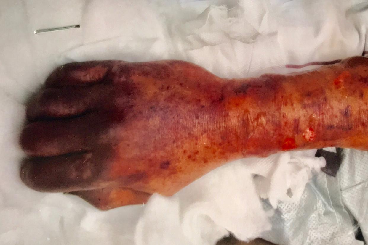 A man's hand covered in blood spots.