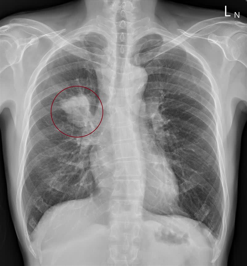 X光果然看到同側的肺部長了一個五公分大的腫瘤。（圖／翻攝自蘇一峰醫師臉書）