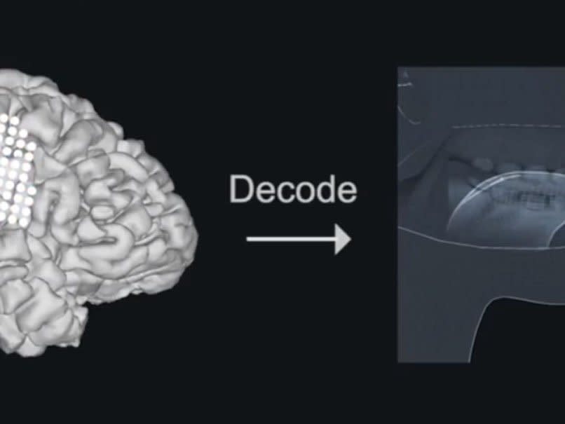 Mind-reading voice box could help doctors connect with patients who cannot talk