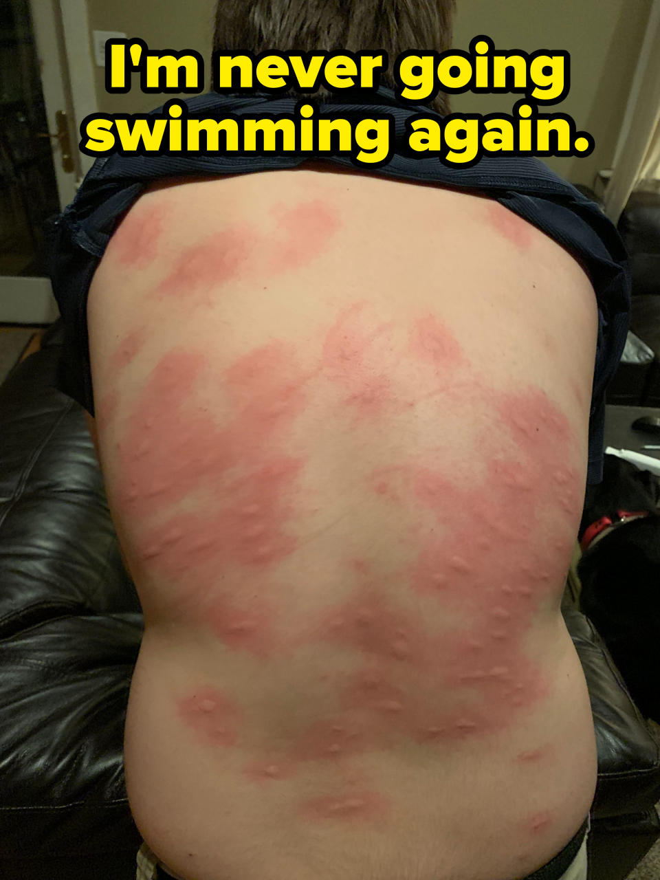 A person's back covered in rashes