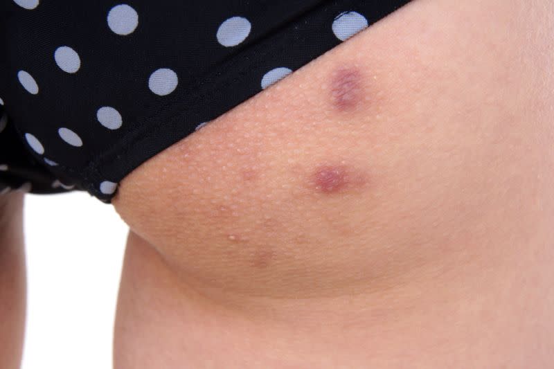 L'acné sur le dos, la poitrine et les fesses : comment se ...