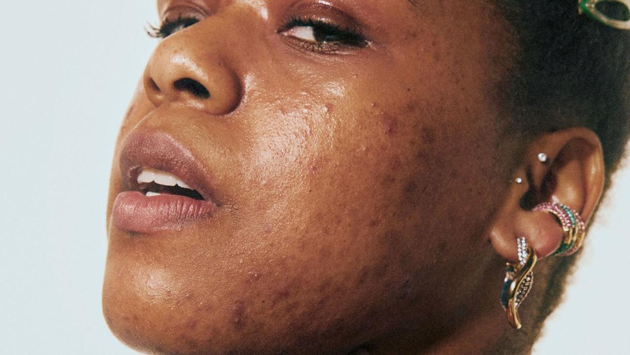 best acne spot treatments