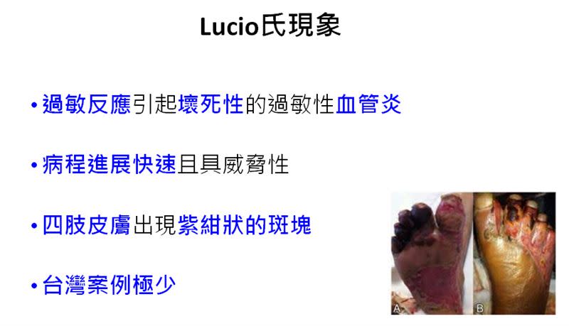 麻生病當中的Lucio氏現象（圖／三總提供）