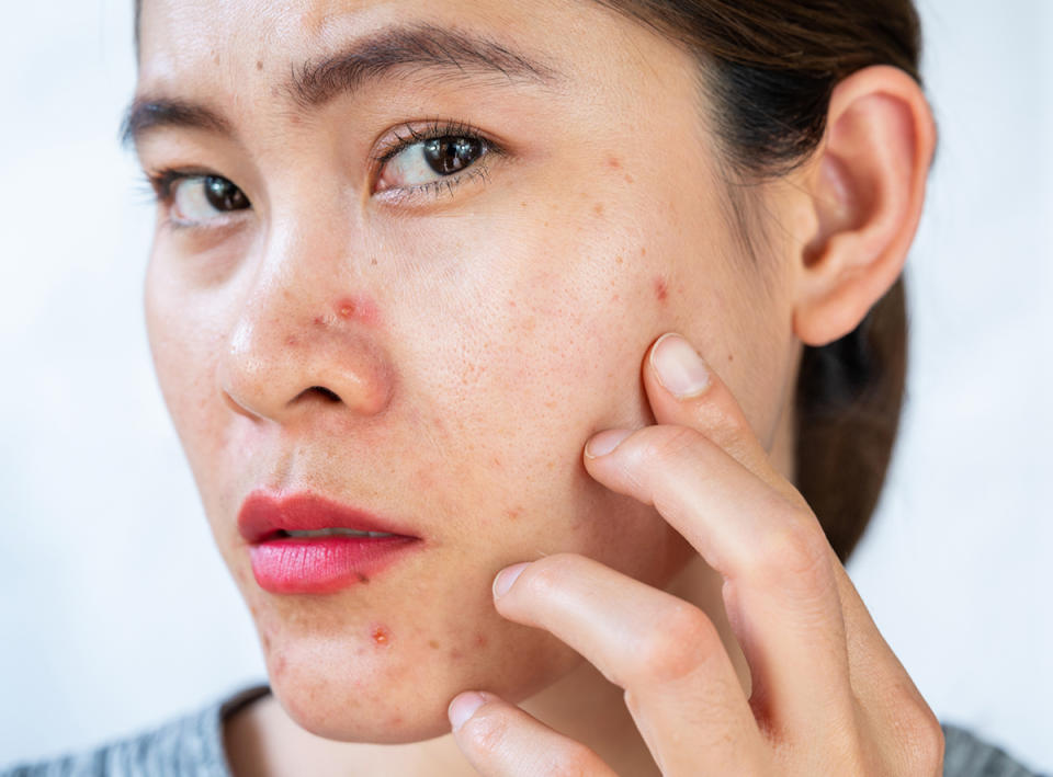 Inflamed acne consists of swelling, redness, and pores that are deeply clogged with bacteria, oil, and dead skin cells. Photo: Getty Images.