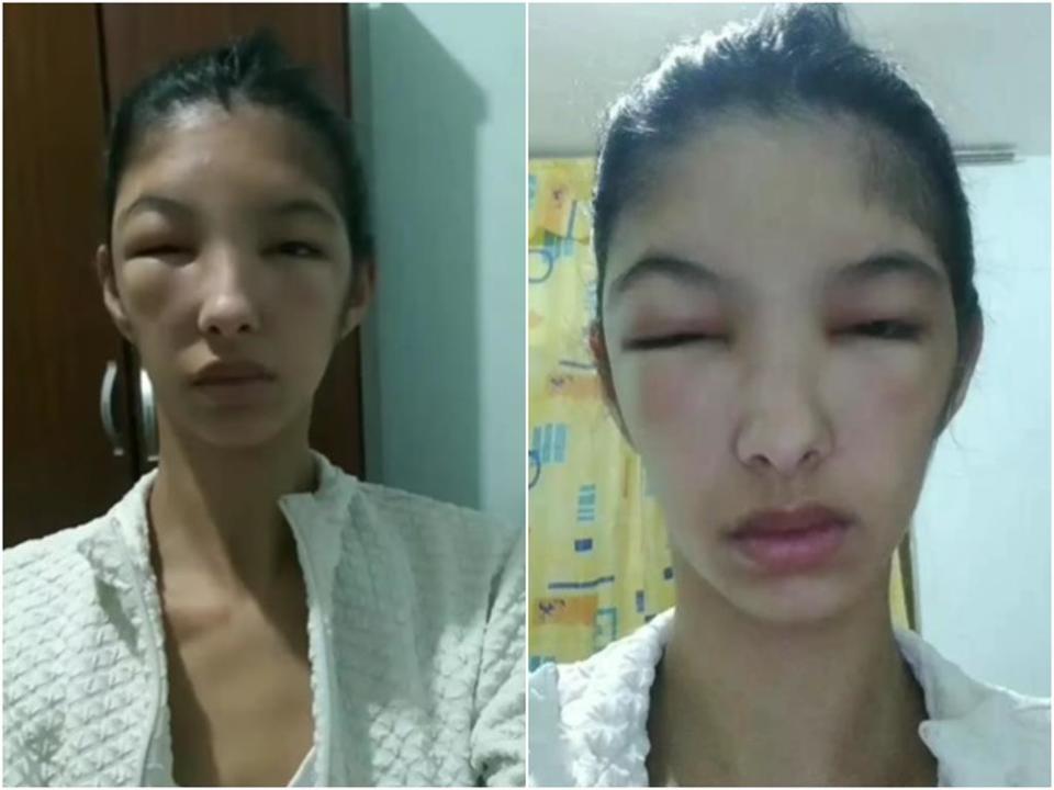 19歲女模染髮後變豬頭！「雙眼腫脹＋頭皮流湯」過敏超嚴重險毀容