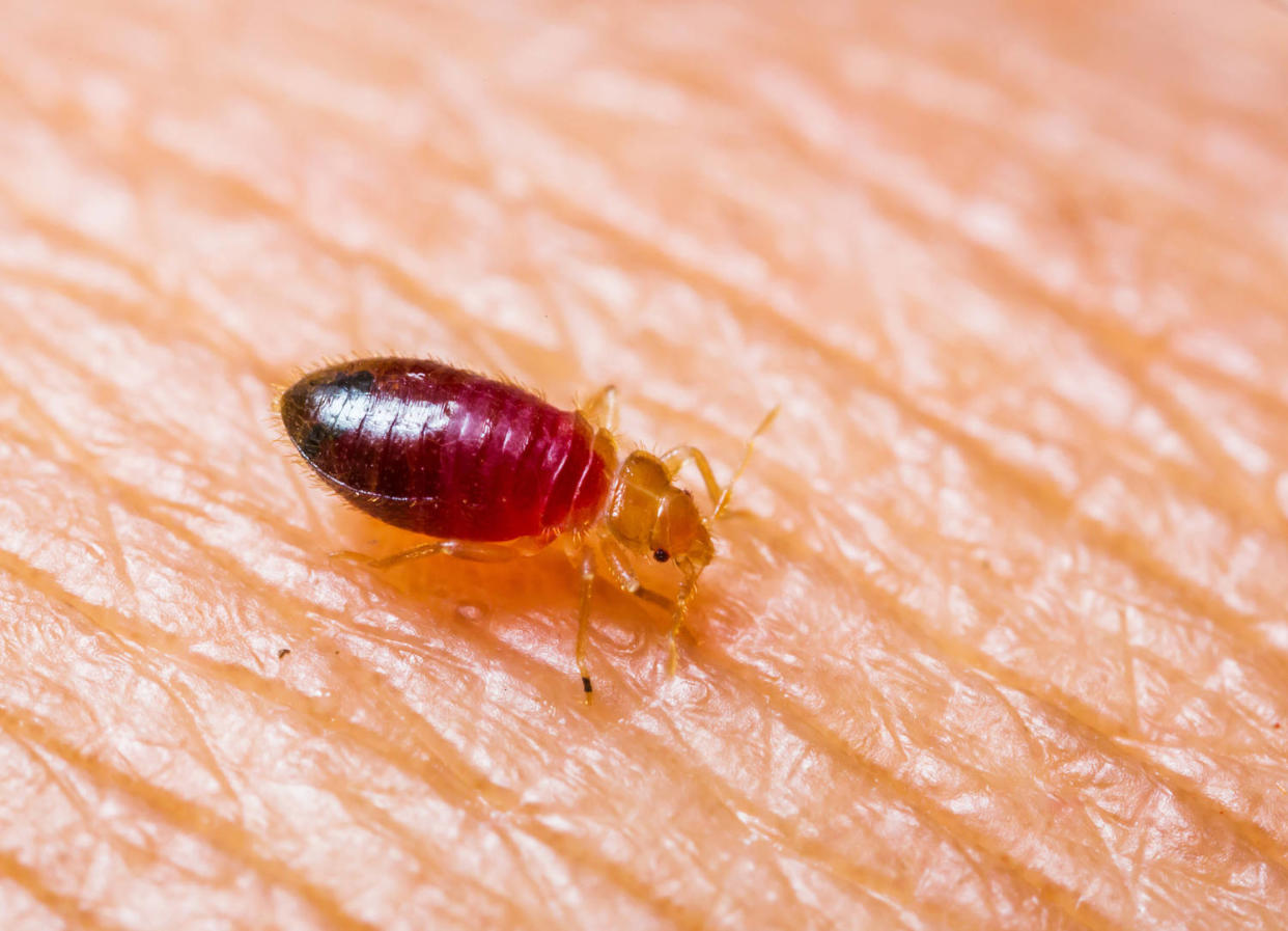 Bedbug Bites  (smua / Getty Images / iStockphoto)