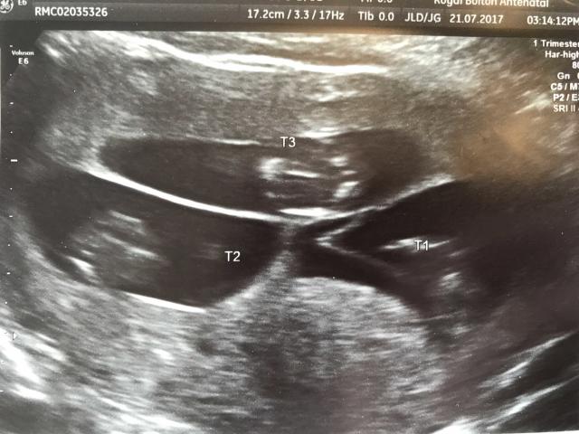 An early scan revealed Nicola was pregnant with triplets [Photo: Caters]