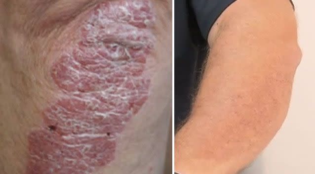 Before and after shots of Mr Walker's psoriasis. Picture: 7 News