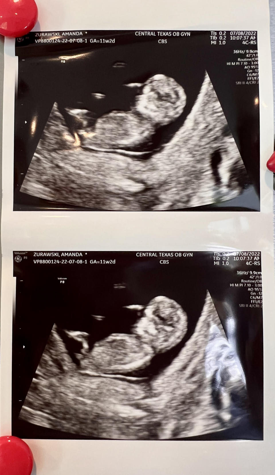 In utero photos of Amanda and Josh's daughter, Willow. (Courtesy Amanda and Josh Zurawski)