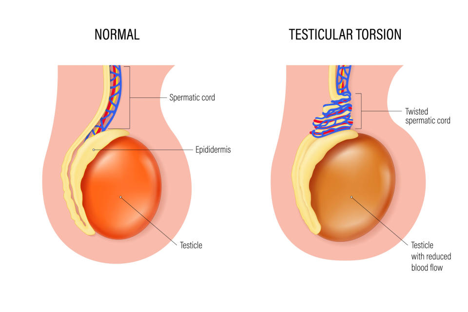 Illustration comparing normal testicular anatomy with testicular torsion, highlighting twisted spermatic cord