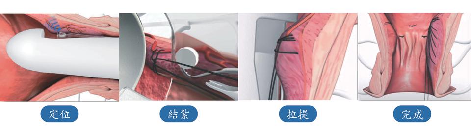 手術使用痔瘡動脈偵測都普勒系統，可同時完成定位痔瘡動脈、結紮、復位。 圖/洪基翔醫師提供。