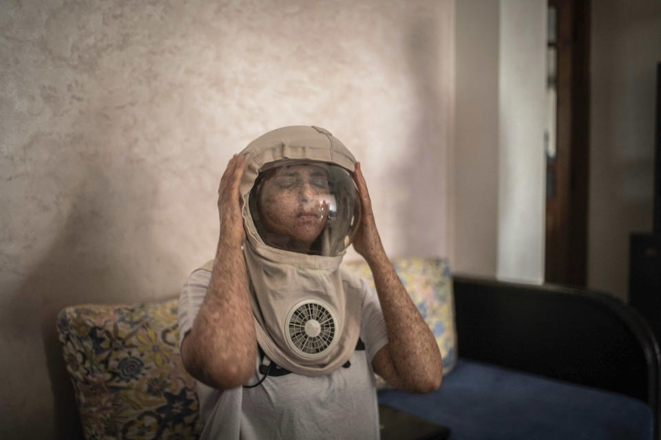 In this Tuesday, July 16, 2019 photo, Fatimazehra El Ghazaoui, 27, a woman affected by a rare disorder called xeroderma pigmentosum, or XP, puts on a protective mask she wears outside on sunny days, in her home in Mohammedia, near Casablanca, Morocco. The disorder affects about 1 in 10,000 people in North Africa _ more than 10 times the rate in Europe and about 100 times the rate in the United States, according to Dr. Kenneth Kraemer, who researches XP at the U.S. National Institutes of Health. (AP Photo/Mosa'ab Elshamy)
