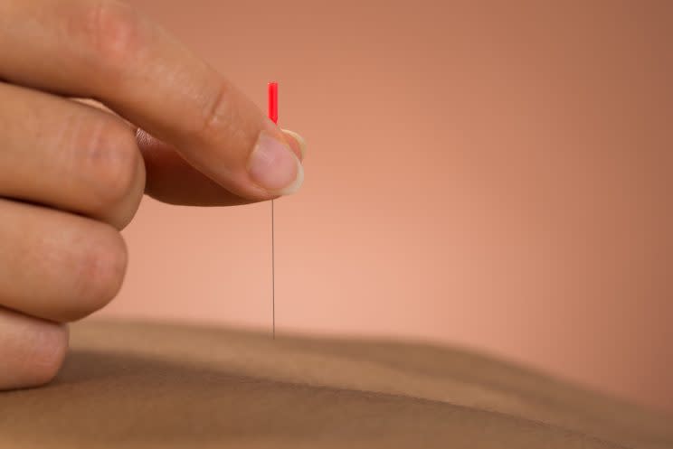 Would you give your baby acupuncture? [Photo: Getty]