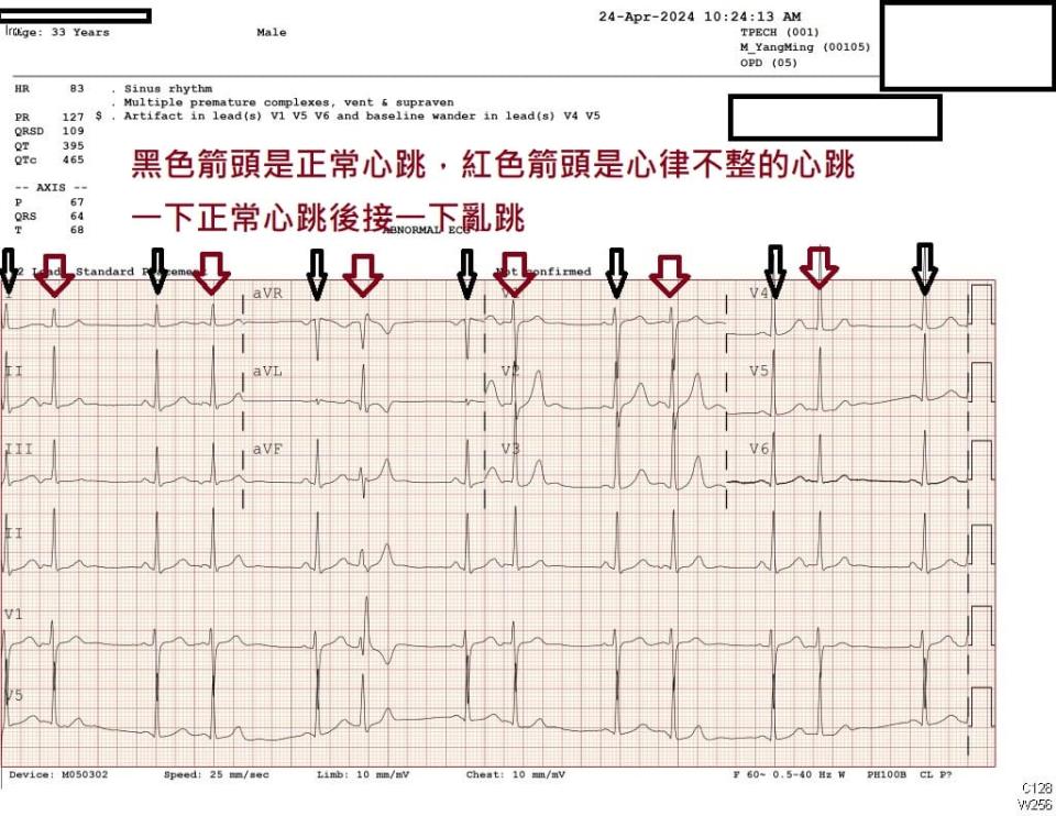 心律不整為一跳正常的心跳後面緊接一跳亂跳的心跳。（圖／翻攝自蘇一峰臉書）