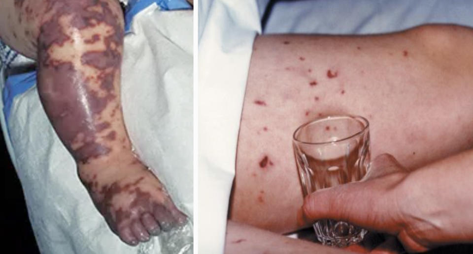 A meningococcal rash on a baby's leg (left) and a person's leg (right). 