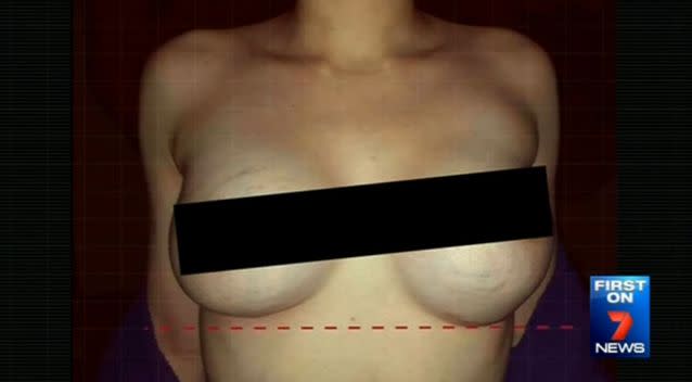A victim has shared a photo of what she calls her 'deformed breasts'. Source: 7News