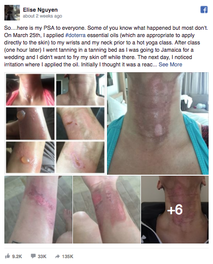 After applying essential oils to her neck and wrist and then used a tanning bed, this woman broke out in blisters and burns.