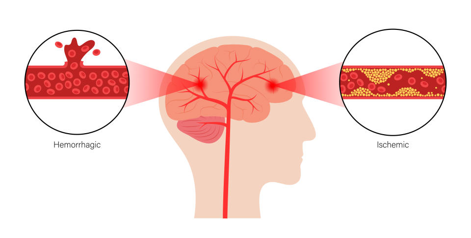 Experts say an ischemic stroke happens when blood clots or other particles block the blood vessels to the brain. (Photo via Getty Images)