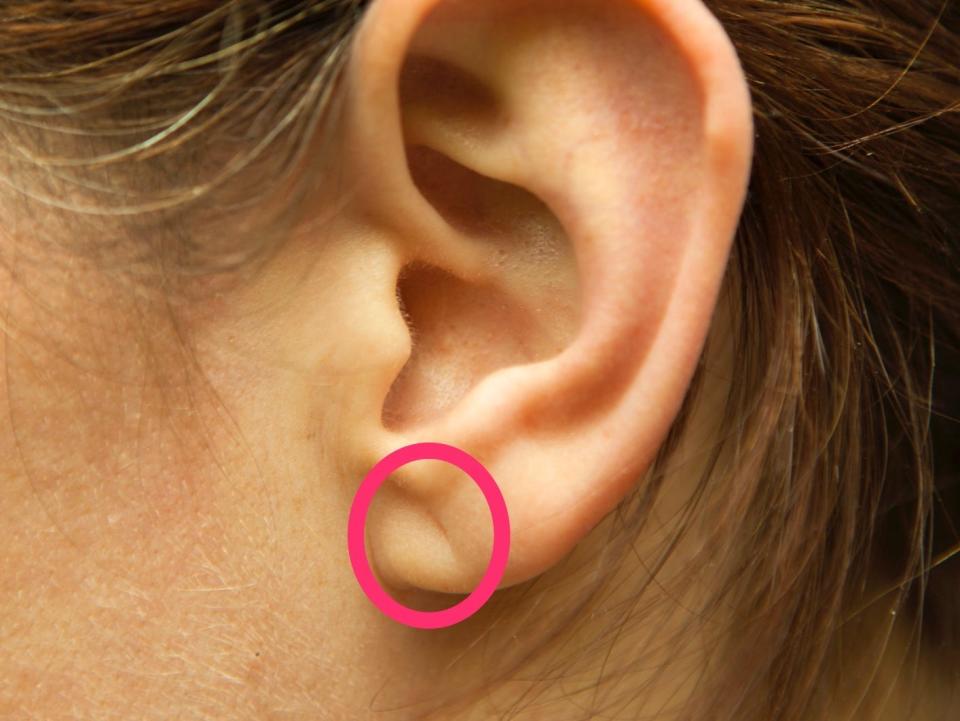 ear crease with a circle