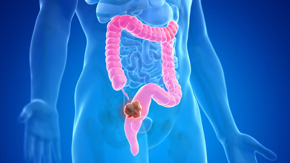 diagram showing a polyp inside a patient's colon