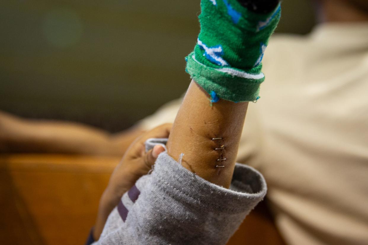 At Mission: Border Hope in Eagle Pass on Friday, 5-year-old Venezuelan Jesús Tortua shows a 2-inch laceration caused by razor wire in the Rio Grande.