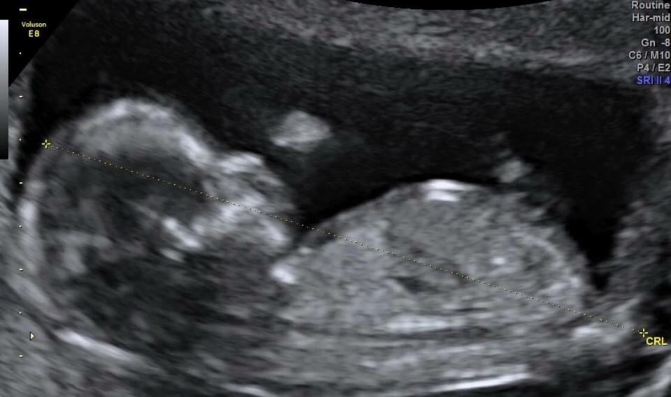 魏如萱還在臉書上傳胎兒的超音波照，看得出新手媽媽的緊張與喜悅。（翻攝自魏如萱臉書）