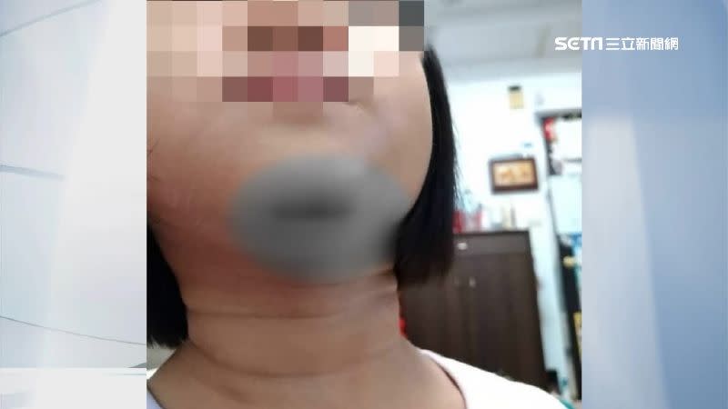 女童縫了20針無大礙。