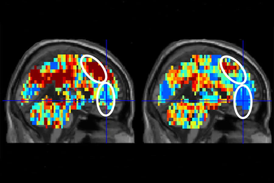 On the left is the brain activation pattern for "death" in participants who had made a suicide attempt. The image in the right depicts the activation pattern for "death" in control participants.