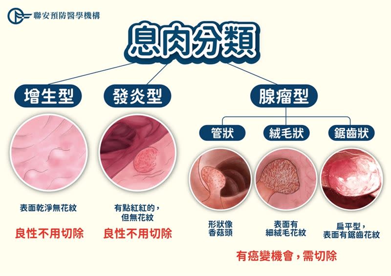 息肉的分類，可依照醫師專業判斷要不要切除。（圖／聯安預防醫學機構提供）