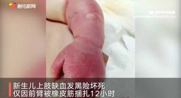 中國大陸一名新手媽媽，用橡皮筋將衣袖固定在嬰兒左手臂上，導致嬰兒險些需被截肢。（圖／翻攝自陸網）