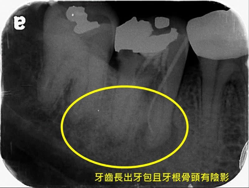 ▲牙齒長出牙包且牙根骨頭有陰影。（圖／奇美醫學中心提供）