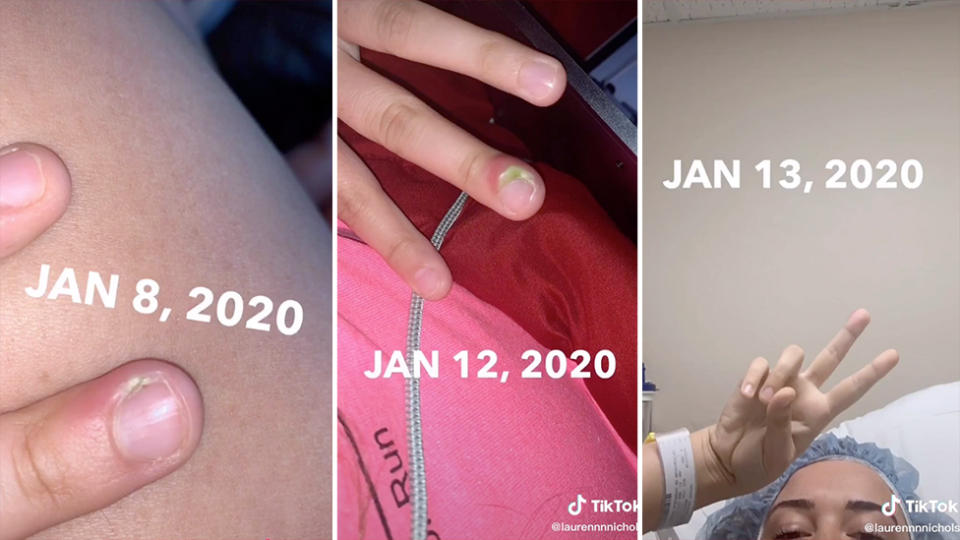 The 18-year-old detailed in a TikTok video (pictured are stills of her infection worsening and a photo of her from hospital) how her nail biting lead to her hospitalisation.