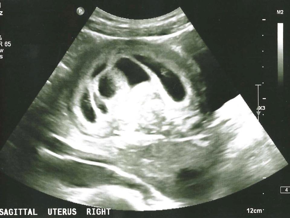 Lizzie Russell's ultrasound showing six babies