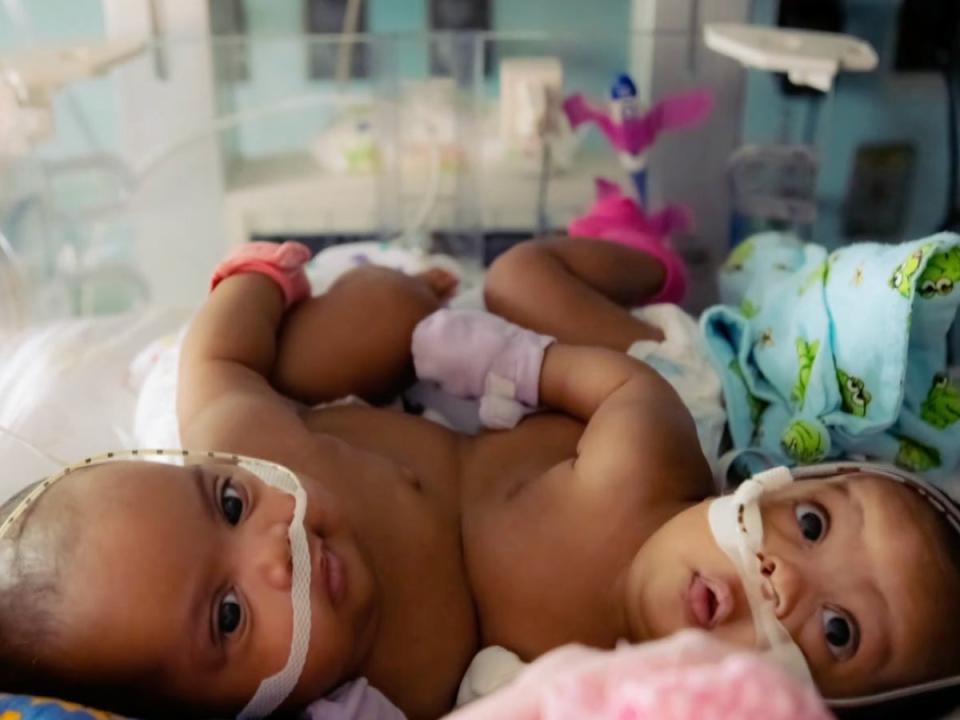 Two conjoined twins were separated during a surgery in Texas (Screenshot / CBS News)