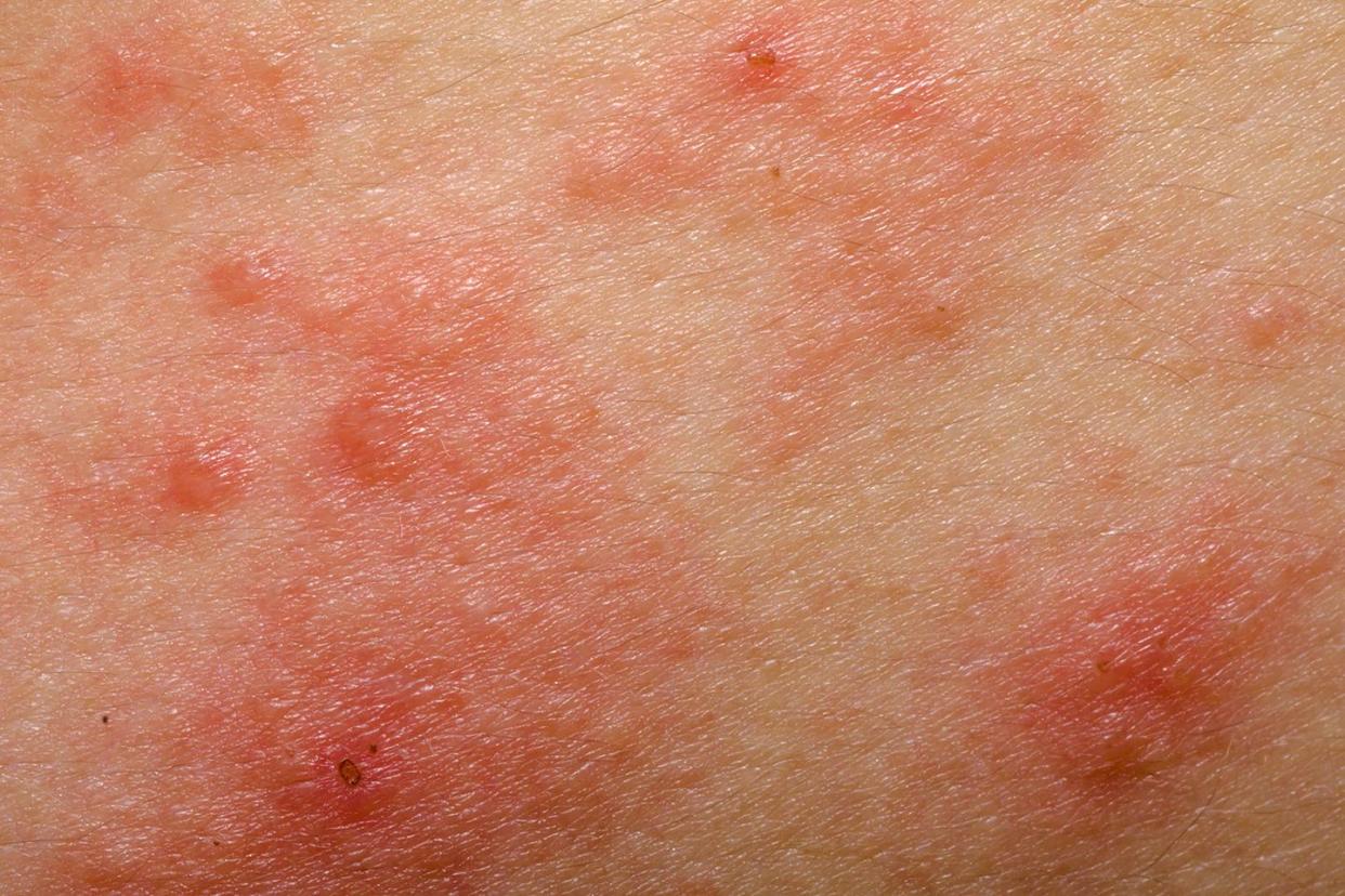 eczema