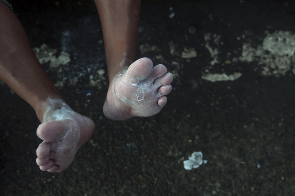 A Honduran migrant shows his blistered feet covered in talcum powder in Tecun Uman, Guatemala, on Sunday, Oct. 21, 2018. (AP Photo/Oliver de Ros)