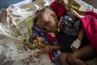 Gebre Kidan Gebrehiwet, 2, is treated for malnutrition after fleeing from the town of Abi Adi with his mother, Abeba Tesfay, at the Ayder Referral Hospital in Mekele, in the Tigray region of northern Ethiopia, on Thursday, May 6, 2021. Birhanu Gebremedhin, health coordinator for the district of Abi Adi, says, “This malnutrition is caused by the conflict. … They’ve stolen their food, their equipment, and some were killed by the troops even. So they are not able to feed their children.” (AP Photo/Ben Curtis)