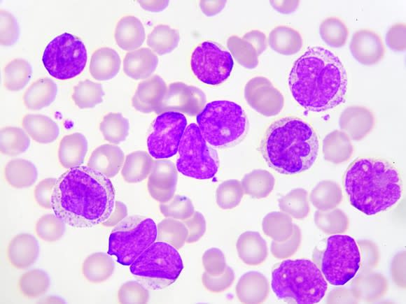 Micrograph of stained leukemia cells