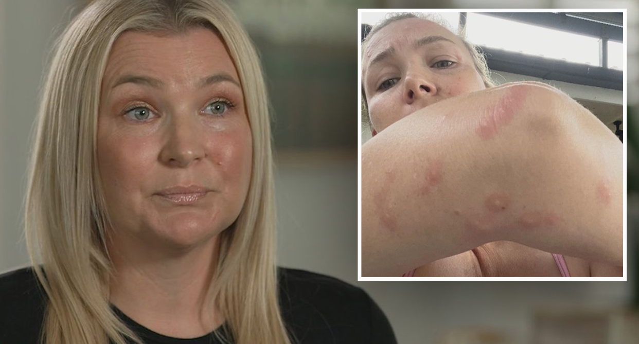 Monica Robertson is pictured with what she said are insect bites all over her elbow an arm. 