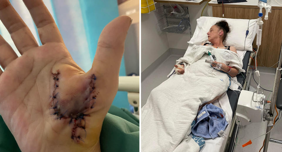 Left, Beth's hand with stitches in a U shape. Right, Beth lies in hospital bed in pain.