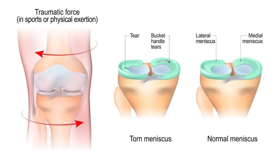 An illustration of a meniscus tear