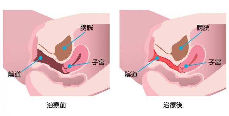 激光修陰機的利與弊