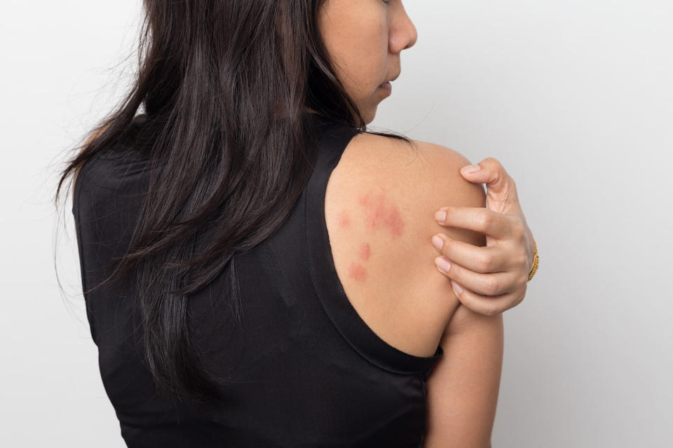 woman showing her skin itching behind , with allergy rash urticaria symptoms (chokja / Getty Images stock)