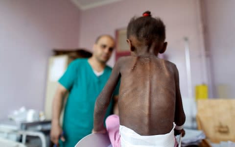 A nurse weighs a malnourished girl at a treatment center in Sanaa, Yemen - Credit: Reuters