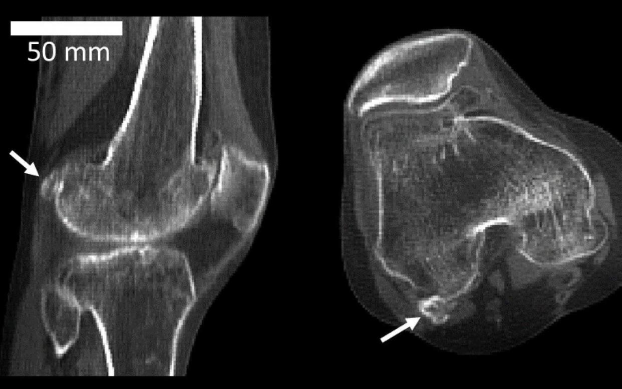 The arrow on the scan shows where the fabella is - behind the knee  - Michael Berthaume/Imperial College London