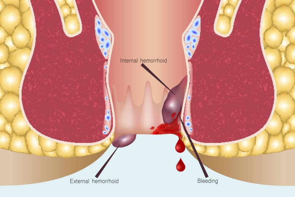 hemorrhoids