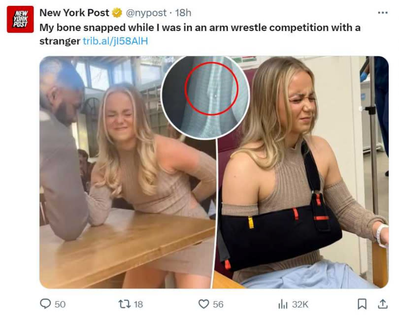 24歲女子在酒吧與一名陌生男子比腕力，沒想到比賽一半手臂突然傳出斷裂聲，手骨當場斷裂。  （圖／翻攝自X）